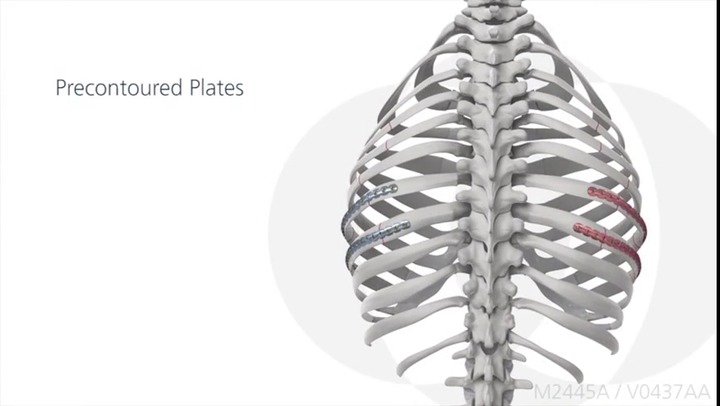 肋骨用圧迫プレート - MatrixRIB™ - Depuy Synthes - 胸骨用 / 胸椎