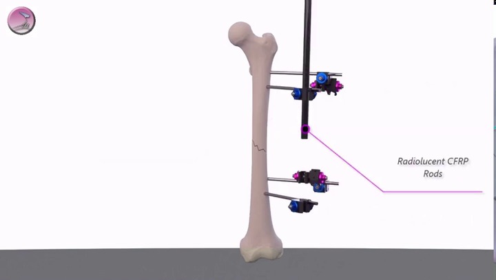 Extra-Caliber (carbon fiber) Radiolucent Tibia/Ankle System